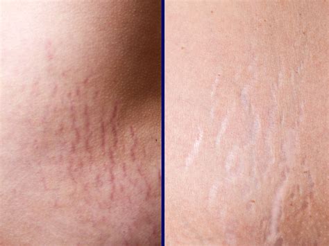 Smagliature rosse e violacee sull'addome