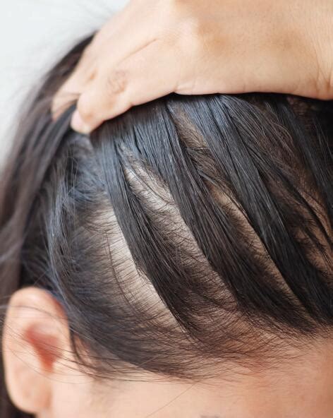 Immagine comparativa: cuoio capelluto sano vs. cuoio capelluto con alopecia areata