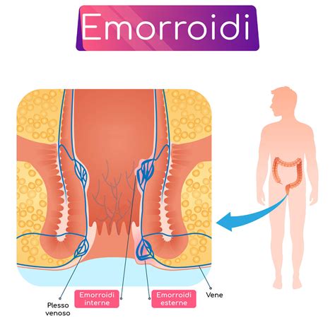 Struttura anatomica del canale anale con emorroidi interne ed esterne