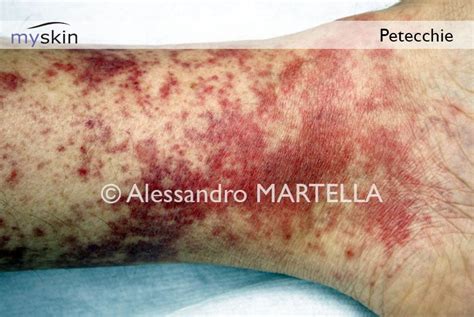 Immagine ravvicinata di petecchie sulla pelle