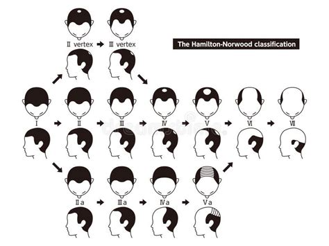 Illustrazione delle diverse forme di alopecia