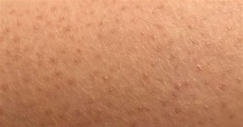 Pelle con cheratosi pilare sulle braccia