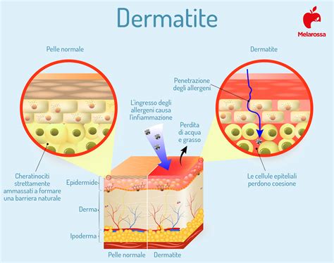 Schema cause dermatite atopica