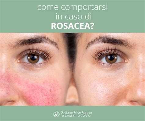 Illustrazione delle diverse fasi della rosacea con arrossamento, teleangectasie, papule e pustole