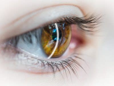 Cornea umana con segno di ulcera