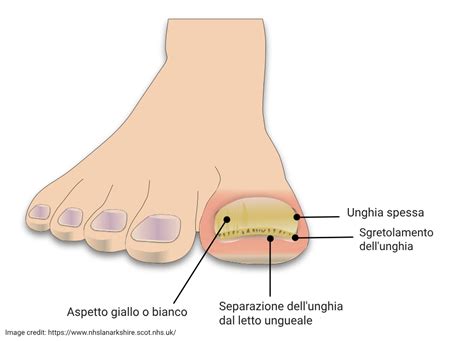 Unghie dei piedi con ispessimento trattate con vaselina