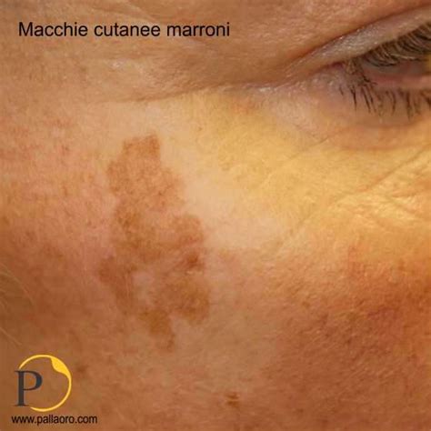 Diagramma che illustra la formazione di macchie cutanee