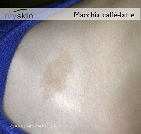 Macchia mongolica sulla regione sacrale di un neonato
