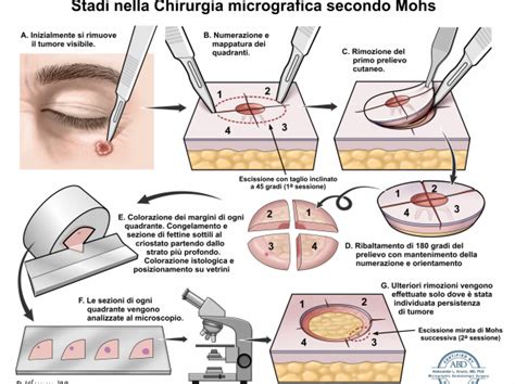Chirurgo che esegue la chirurgia di Mohs