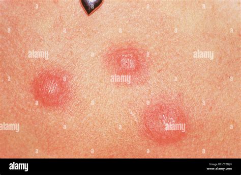 Illustrazione di funghi dermatofiti che attaccano la pelle