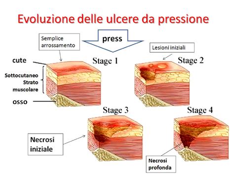 Schema grafico con i diversi stadi di un'ulcera da pressione (Stadio I, II, III, IV)