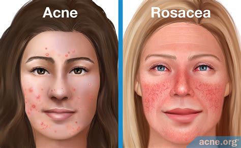Differenza tra Acne e Rosacea