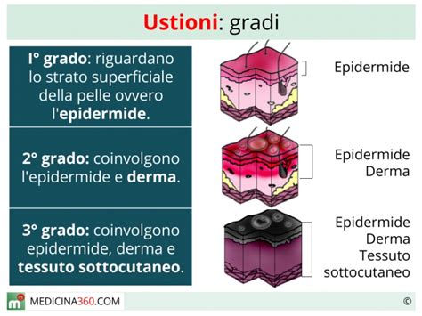 Infografica che illustra i sintomi comuni delle ustioni solari