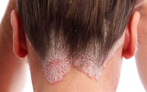 Cuoio capelluto con placche di psoriasi