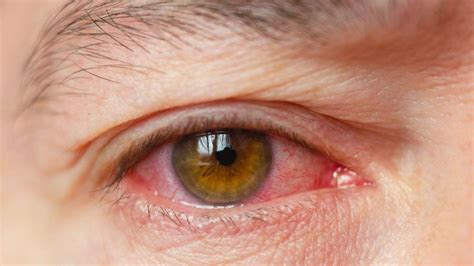 Occhio irritato e arrossato, sintomo di rosacea oculare
