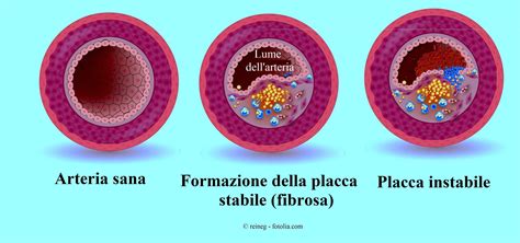 Schema di un'arteria sana e di un'arteria con placche aterosclerotiche