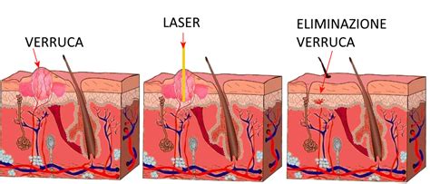Immagine che illustra il processo di crioterapia per la rimozione di una verruca