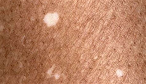 Pelle abbronzata con macchie bianche