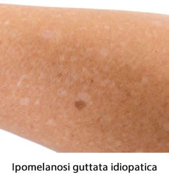Pelle con ipomelanosi guttata idiopatica