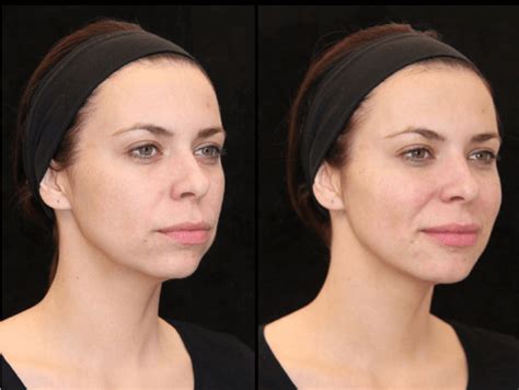 Donna con zigomi definiti e voluminosi