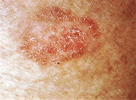 Carcinoma a cellule squamose sul cuoio capelluto