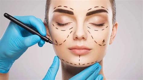 Schema che illustra le linee di incisione tipiche di un lifting del viso e le aree potenzialmente interessate da alopecia temporanea