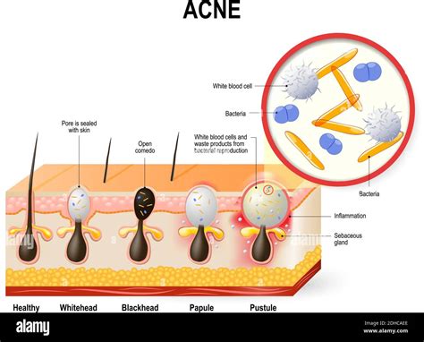 Struttura di un poro ostruito con batteri dell'acne