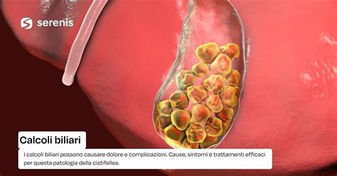 dotti biliari ostruiti da calcoli