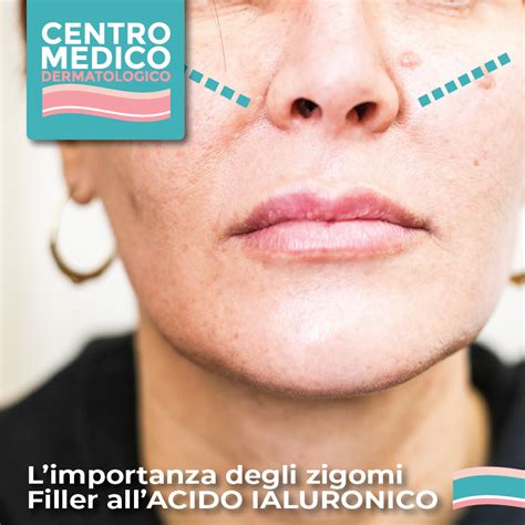 Grafica che illustra la zona degli zigomi