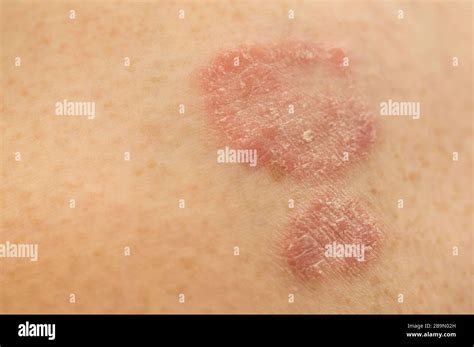 Immagine di una placca cutanea eritematosa, tipica di alcune manifestazioni di linfoma cutaneo