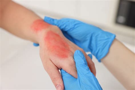 Rami di pero con sintomi di ustione batterica