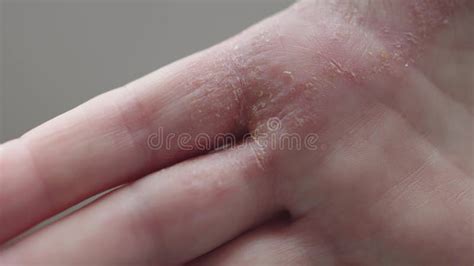 mano con eritema e desquamazione