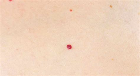 Accumulo di impurità sulla pelle