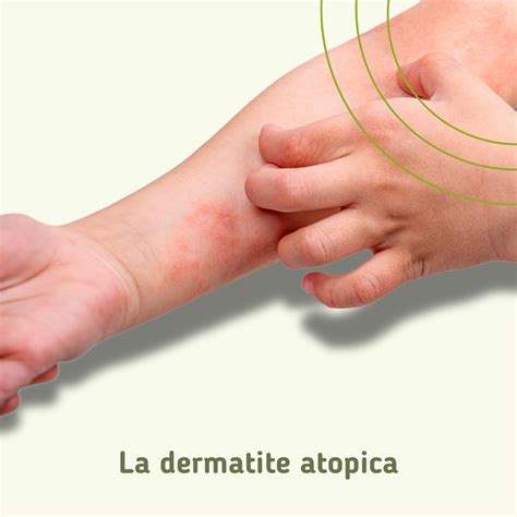 Copertina di una rivista medica che tratta di dermatite atopica