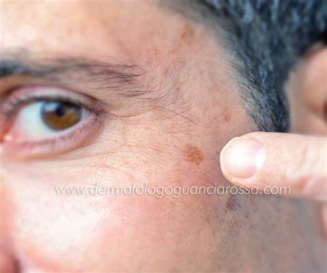 Schema riassuntivo delle cause delle macchie cutanee