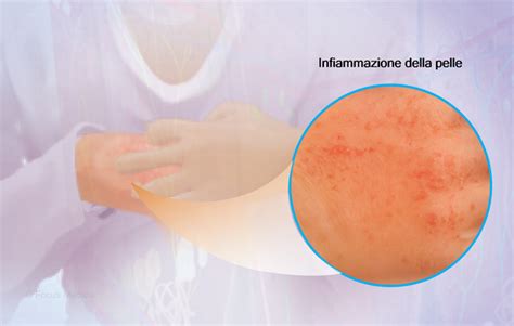 Gomito con pelle ispessita e secca