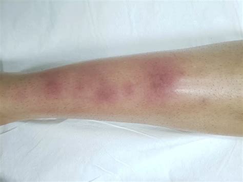 Eritema nodoso su gamba