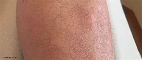 Gambe con noduli rossi e violacei tipici dell'eritema nodoso