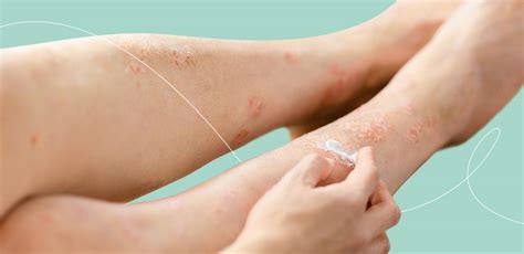 Gambe con segni di dermatite da stasi: gonfiore, arrossamento e iperpigmentazione