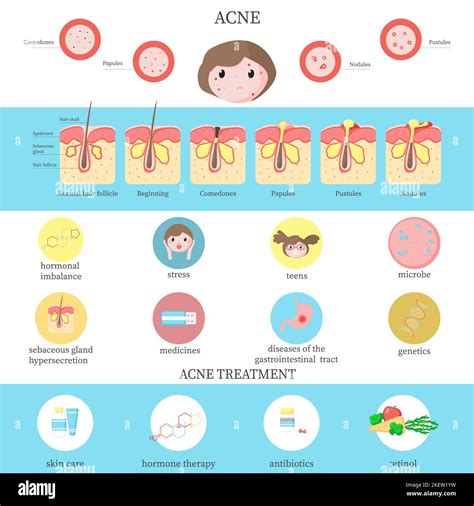 Illustrazione del processo infiammatorio dell'acne