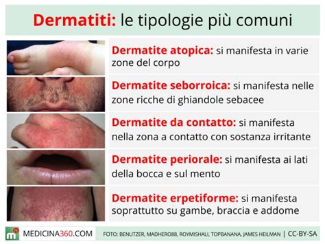 Schema di una dermatite da contatto sul pene