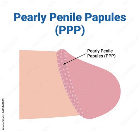 Illustrazione delle papule perlacee peniene