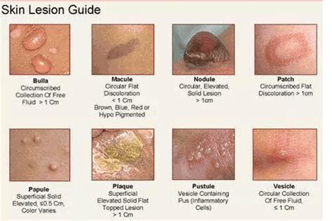 Infografica sui diversi tipi di lesioni cutanee sul pene