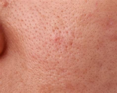 Grafico che illustra le principali cause dei pori dilatati