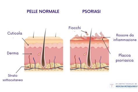 Diagramma del ciclo di vita delle cellule cutanee nella psoriasi rispetto alla pelle sana
