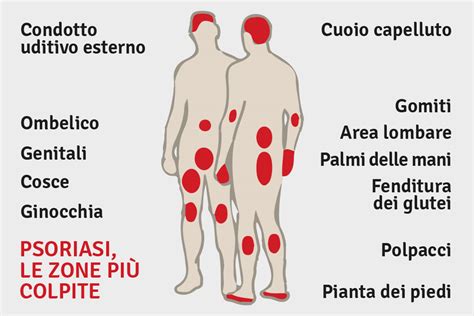 Schema anatomico del viso che evidenzia le aree più comunemente colpite dalla psoriasi