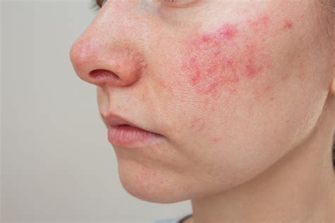 Schema della classificazione ROSCO per la rosacea