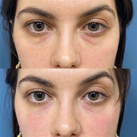 Occhi con occhiaie prima e dopo l'applicazione di olio di mandorle