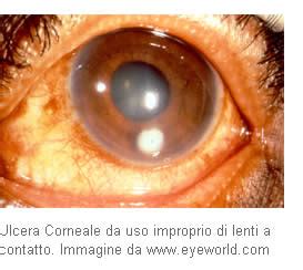 Esempi di cheratiti: ulcera dendritica, infiltrato corneale