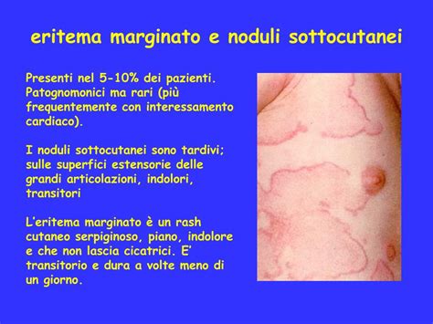 Noduli sottocutanei tipici dell'eritema indurato di Bazin sulle gambe